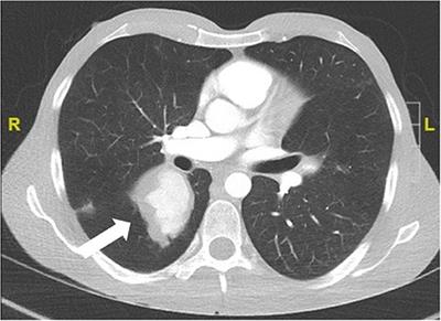 Behçet‘s Syndrome Apart From the Triple Symptom Complex: Vascular, Neurologic, Gastrointestinal, and Musculoskeletal Manifestations. A Mini Review